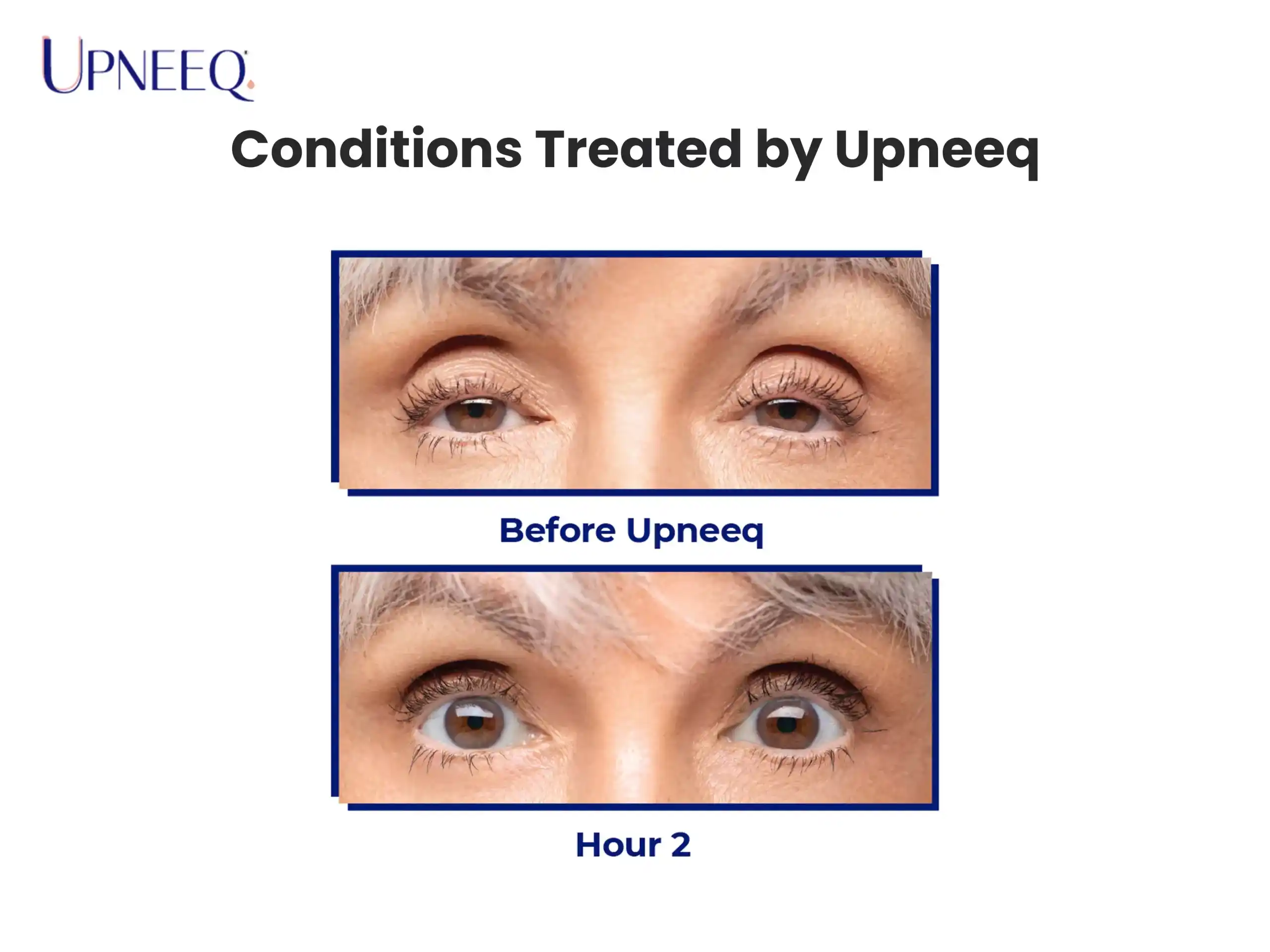 Conditions Treated by Upneeq
