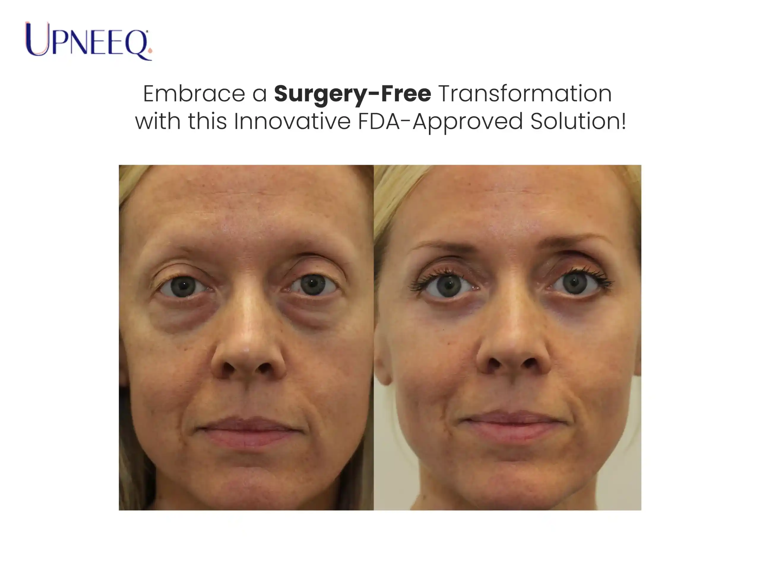 Embrace a Surgery-Free Transformation with this Innovative FDA-Approved Solution
