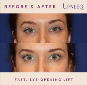 Upneeq â The first Non-Surgical Approach to Eye Aesthetics