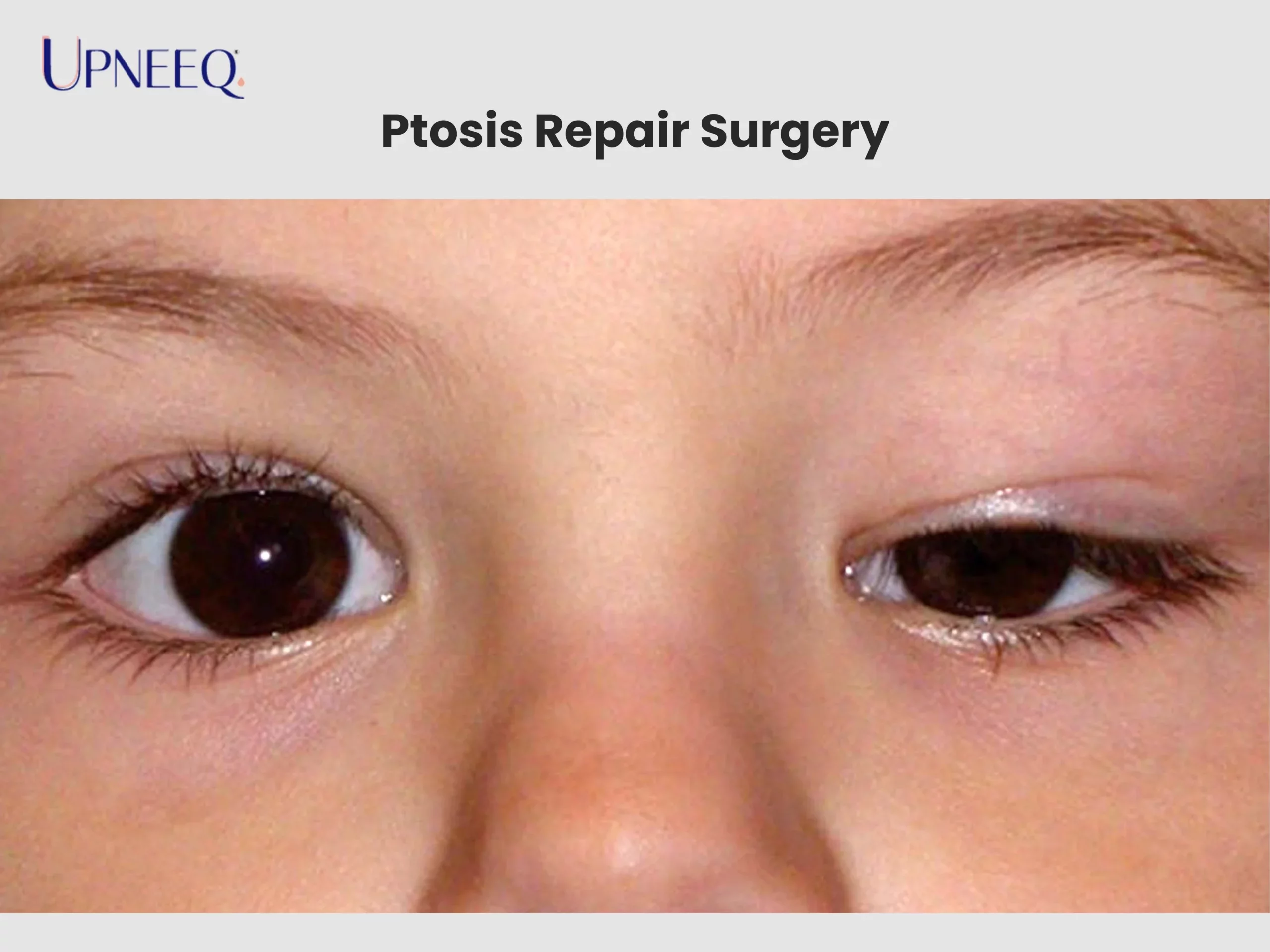 Ptosis Repair Surgery