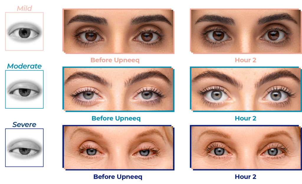 Upneeq eye drops before and after