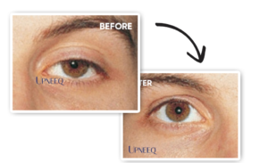 Upneeq for stroke ptosis