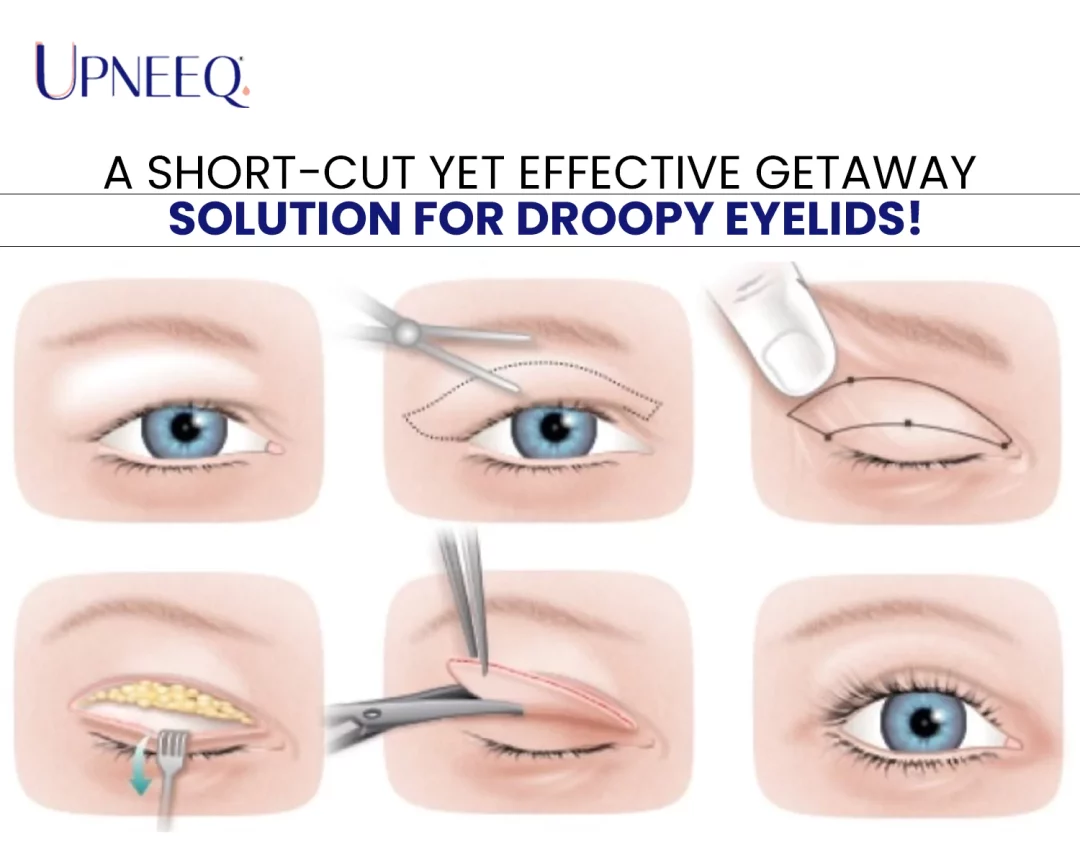 A Short-Cut Yet Effective Getaway Solution for Droopy Eyelids!