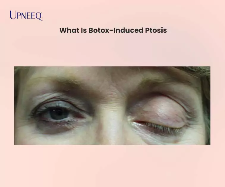 What Is Botox-Induced Ptosis