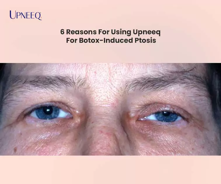 6 Reasons For Using Upneeq For Botox-Induced Ptosis